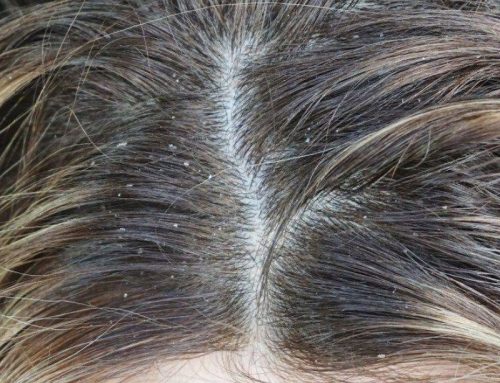 Come trattare la forfora e gli odori sgradevoli del cuoio capelluto